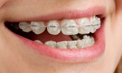 Clear Braces, Ceramic Braces Canberra